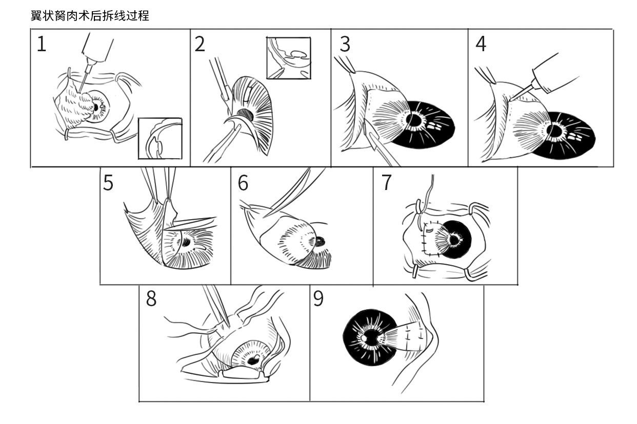 翼状胬肉术后拆线过程图