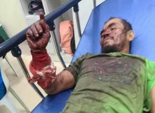 菲律宾男子咬死3米巨蟒：遭蟒蛇咬伤缠身后，他狠咬蛇脖子自救